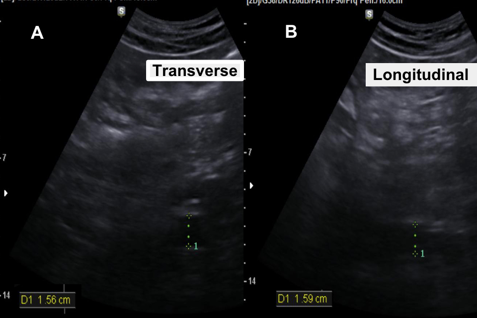 Transverse and longitudinal images of the aorta next to each other. The gain is too low and the focus position is high, making it hard to tell the difference between the 2.