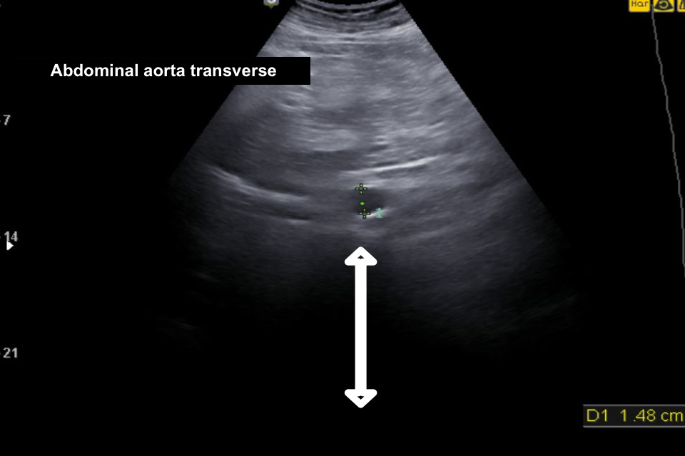 A transverse image of the aorta where the anterior border of the lumbar spine is just about visible, but there is an excess of depth more than 7cm beneath it.