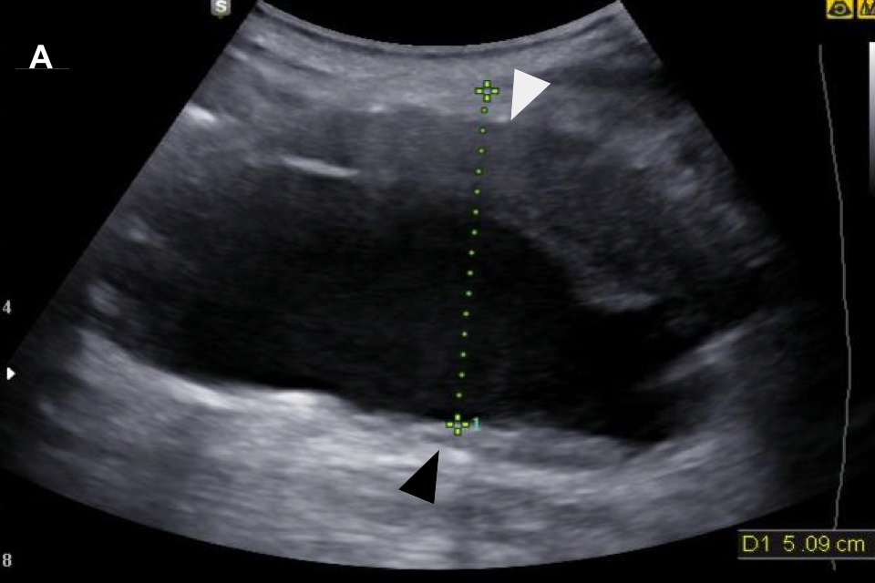 A scan image where the anterior calliper has been placed outside the aortic wall.