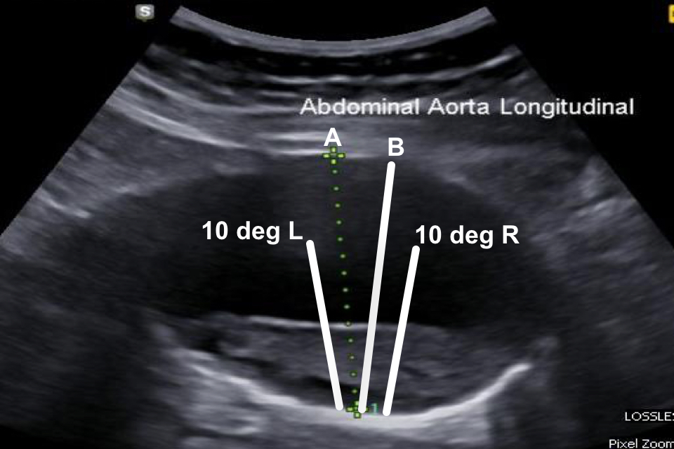 A scan image where the diameter of the aorta has been measured in a slanting direction, with lines drawn on to show the correct line of measurement.