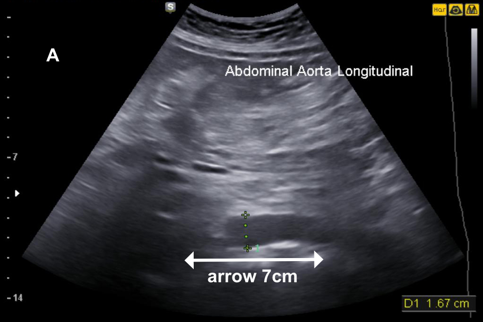 A longitudinal image where only a short (4 to 5cm) length of the aorta has been captured