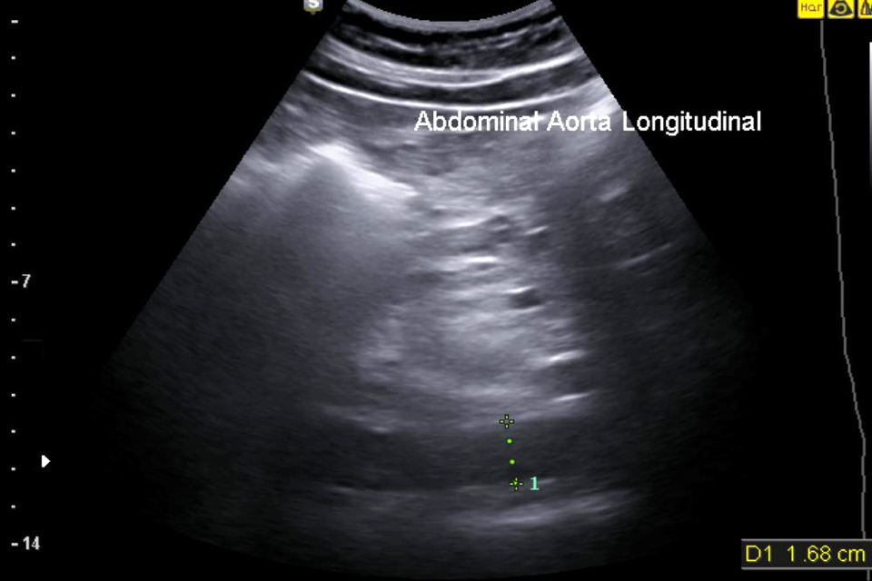 A second image to accompany figure 7A showing a further section of the aorta.