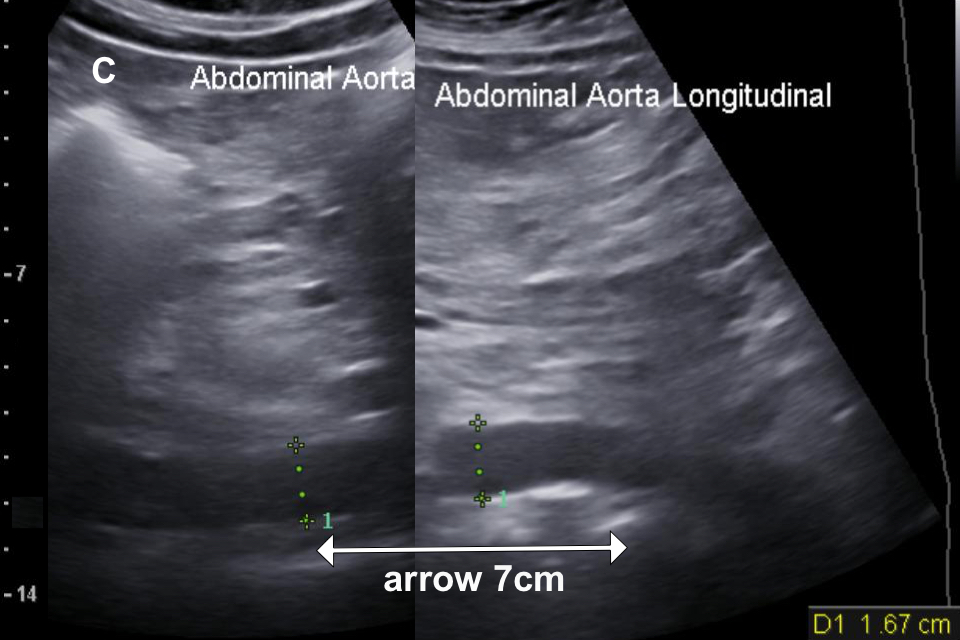 A composite of two scan images (figures 7A and 7B) placed next to each other to show a longer section of the aorta