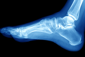 X-ray of an ankle
