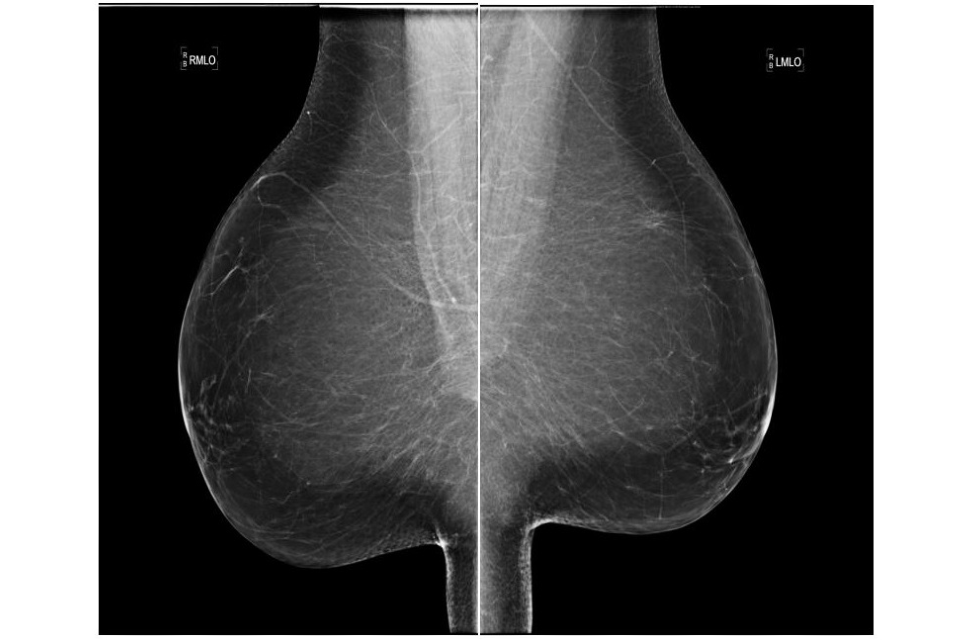 Interventional mammography