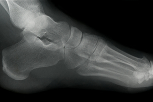 xray of ankle