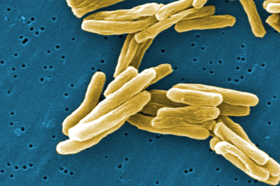 UKHSA launches long term action plan to reduce tuberculosis in England