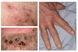 UKHSA latest findings into monkeypox outbreak - GOV.UK