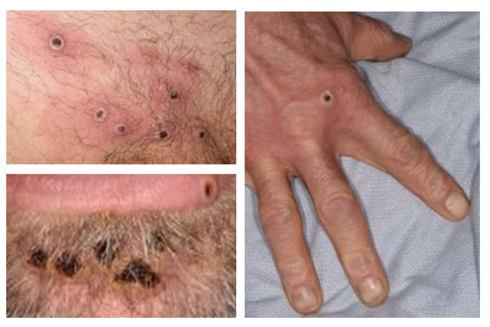 UKHSA latest findings into monkeypox outbreak