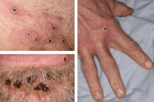 Monkeypox collage