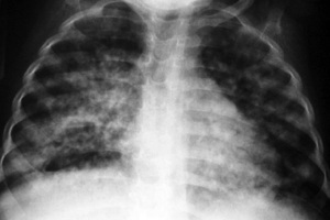 A black and white image of lungs taken by x-ray