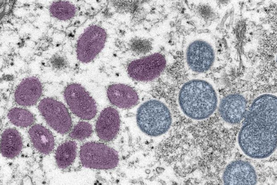 Study launched to find out more about mpox immunity