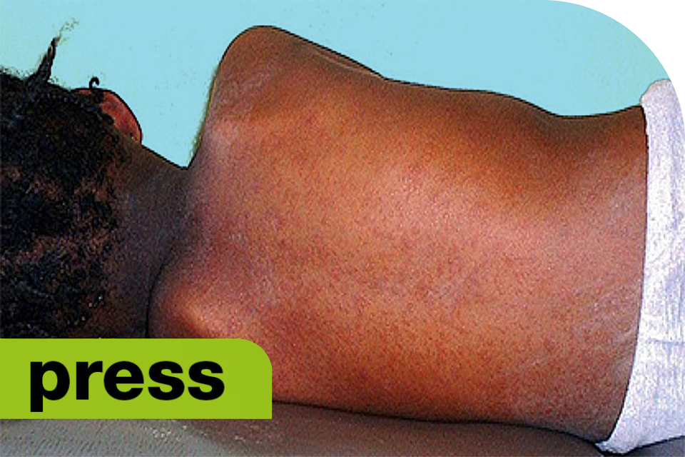 UKHSA warns of back to school measles surge